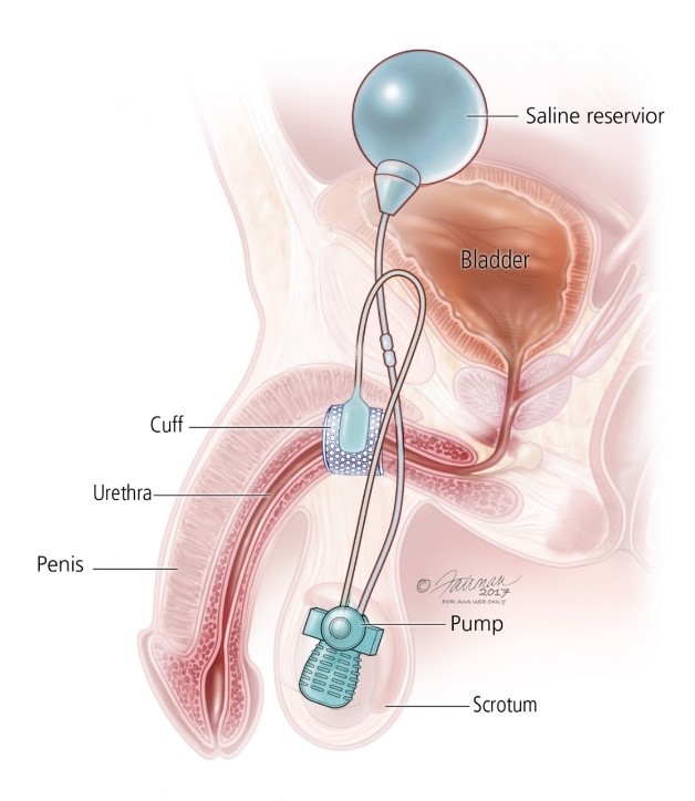 Post-Op Urinary Retention and Why You Can't Pee After Surgery