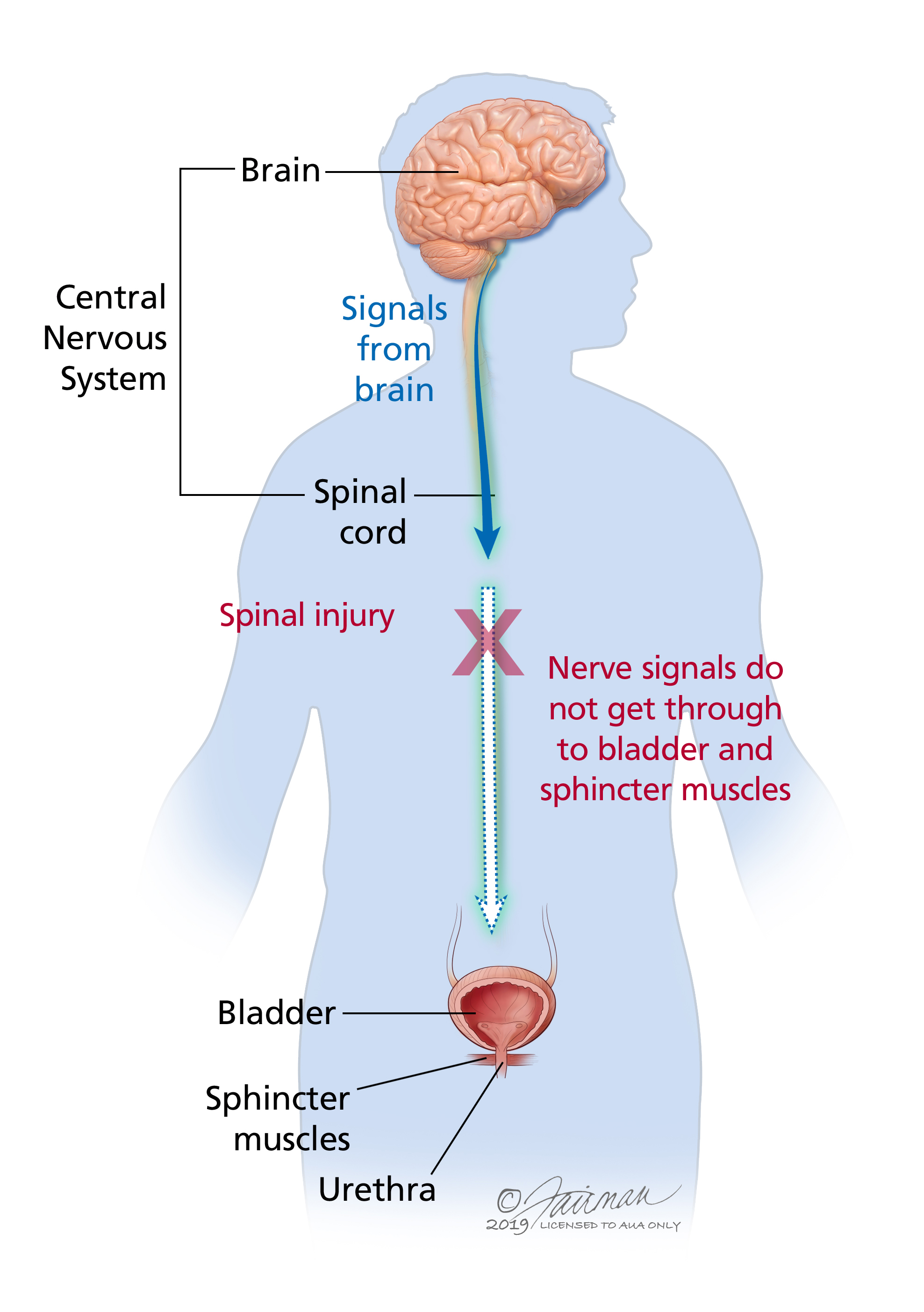 Neurogenic Bladder: Symptoms, Diagnosis & Treatment - Urology Care  Foundation