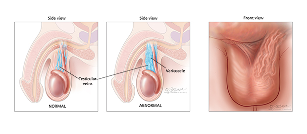 Varicocele Recurrence After Surgery Treatment Options